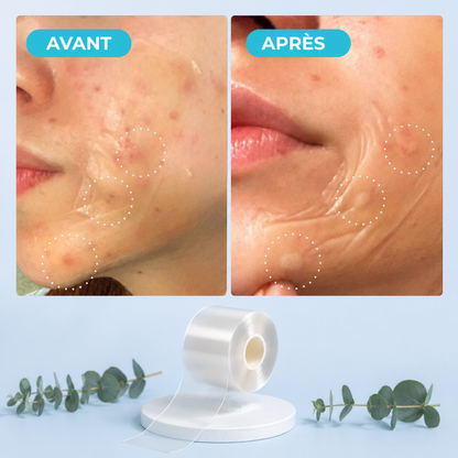 Rouleau Hydrocolloïde Anti-Molluscum Nyvo™