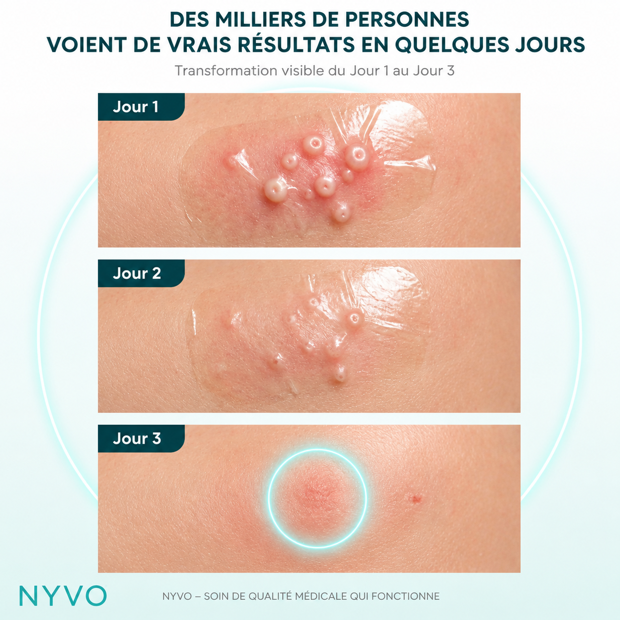 Rouleau Hydrocolloïde Anti-Molluscum Nyvo™